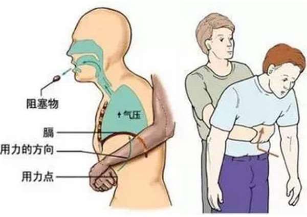 how-to-do-when-fishbone-stuck-in-the-throat-04