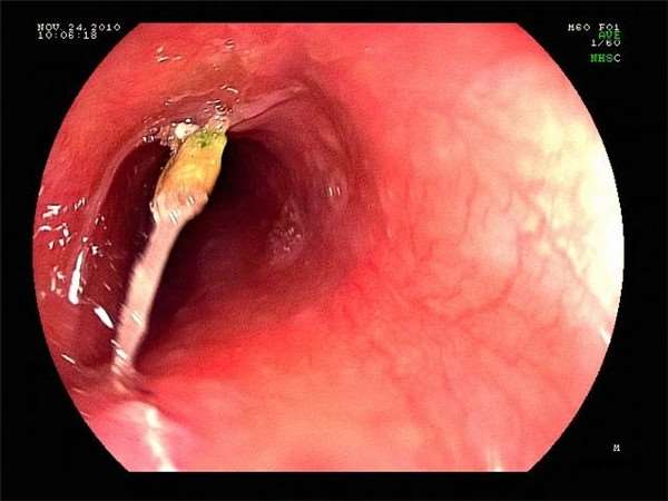 how-to-do-when-fishbone-stuck-in-the-throat-09