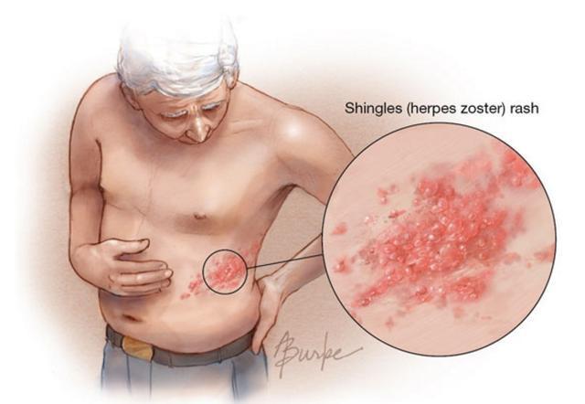 varicella-zoster-virus-01