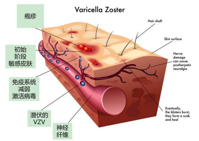 varicella-zoster-virus-03