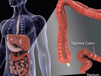 Four-major-symptoms-of-colorectal-cancer-01